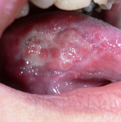 口咽癌 (24)