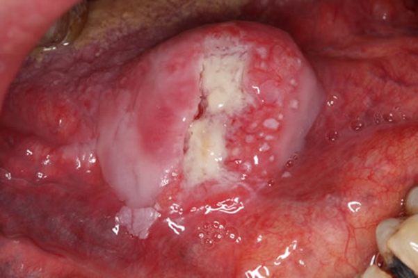 口咽癌 (19)