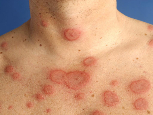 玫瑰糠疹早期症状图片