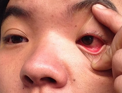 眼结膜炎症状图片 (56)