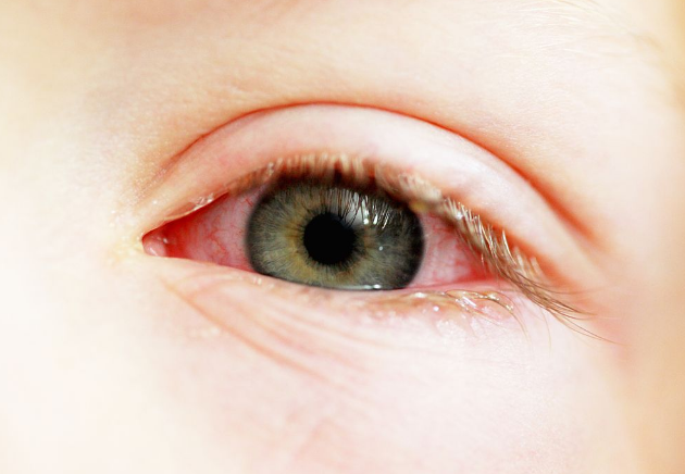 眼结膜炎症状图片 (7)
