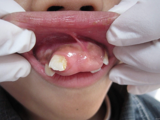 牙龈瘤与牙龈癌 肿瘤图片