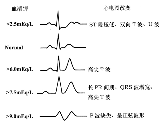 高血钾心电图表现图形图片