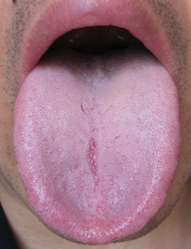 舌炎的症状图片舌图片