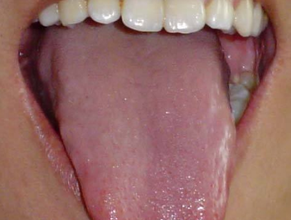 胃阴虚的舌苔图片图片