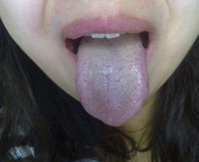 胃炎的症状舌头图片 (59)