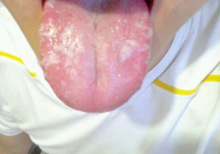 胃炎的症状舌头图片 (56)