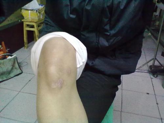 膝盖受伤图片 (5)