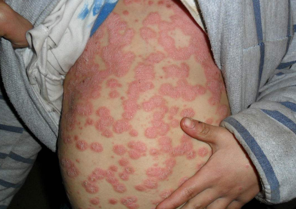 早期梅花康疹症状图片图片
