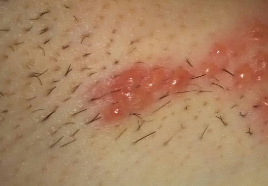 蜘蛛尿引起的皮肤病图片
