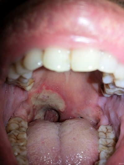 口腔长瘤子图片图片