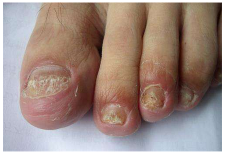 关于手指甲的各种病症图片