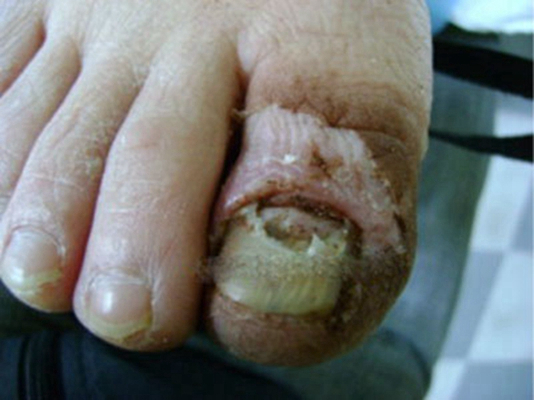 指甲真菌感染的症状图片