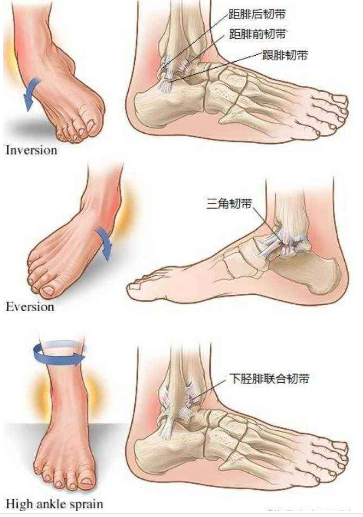 脚踝韧带拉伤 (9)