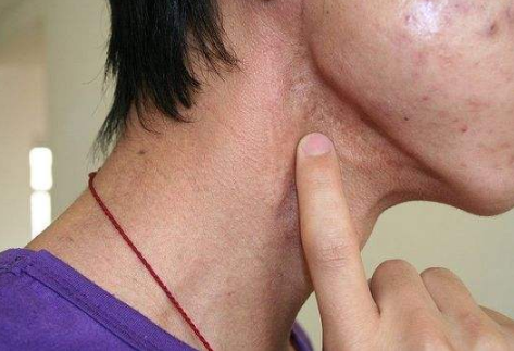 梅毒二期 脖子图片