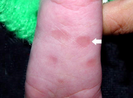 儿童梅毒早期症状图片图片