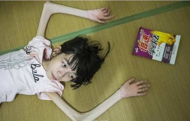 中国厌食症患者照片图片