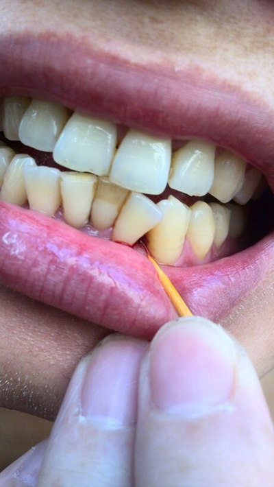 牙釉质发育不全 (16)