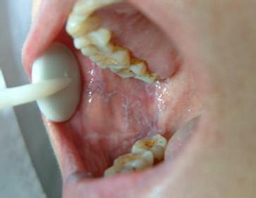 牙釉质发育不全 (13)