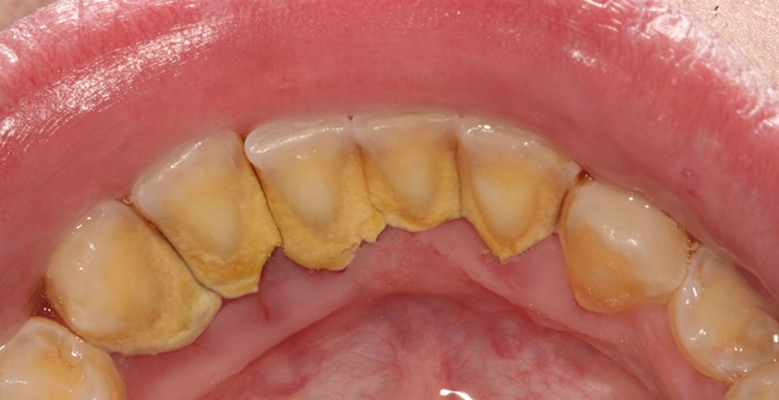 牙釉质发育不全 (43)