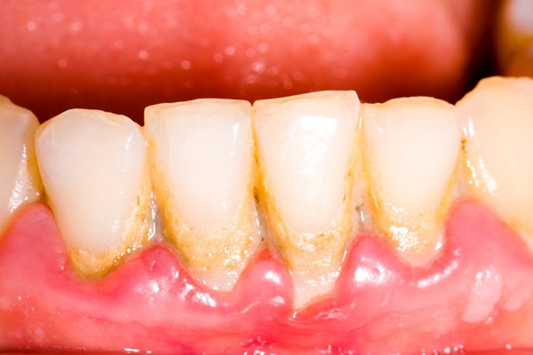 牙釉质发育不全 (51)