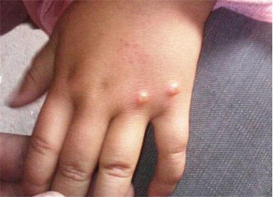 儿童起水痘的症状图片图片