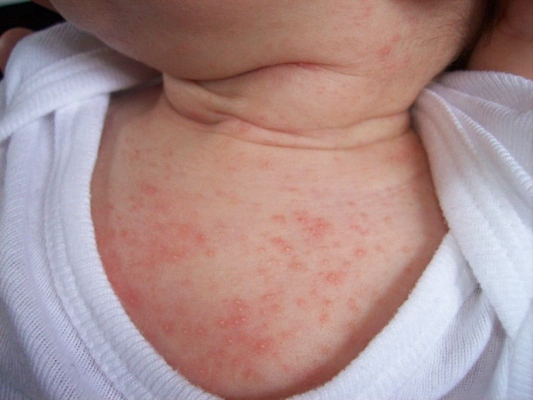 婴儿风疹的症状图片图片
