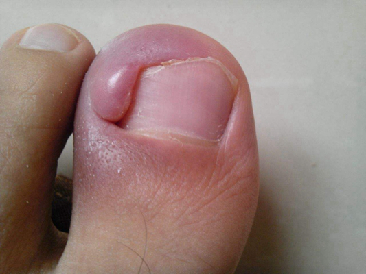 指甲腺炎的症状图片图片
