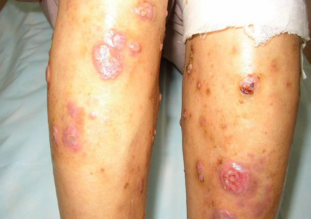 男性梅毒二期症状图片