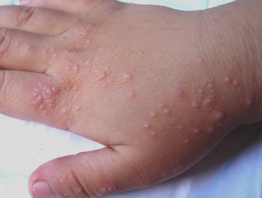 各种湿疹的图片初期图片