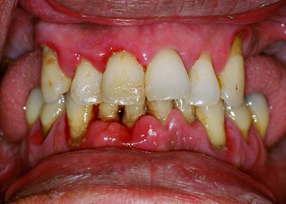 牙釉质发育不全 (41)