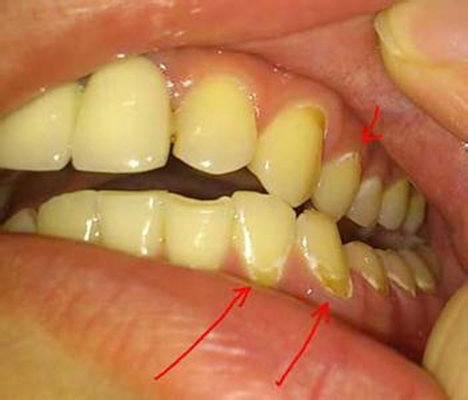 牙釉质发育不全 (52)