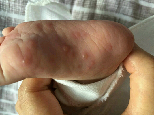小儿水痘早期图片