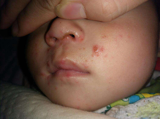 宝宝出水痘图片婴儿图片