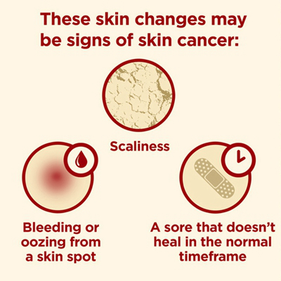 皮肤癌的早期特征图片 (1)