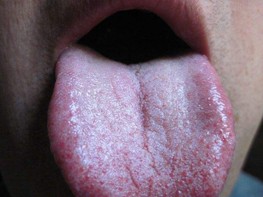 舌苔有裂纹 (4)