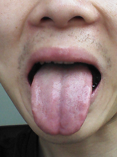 舌苔有裂纹 (37)