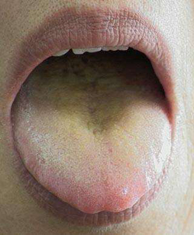 舌苔有裂纹 (48)