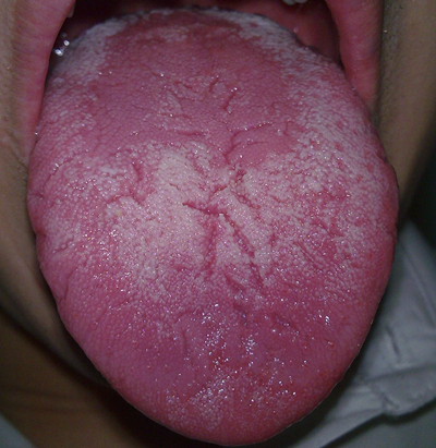 舌苔有裂纹 (42)