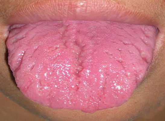 舌苔有裂纹 (1)