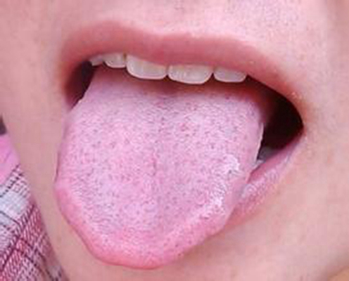 舌苔有裂纹 (12)