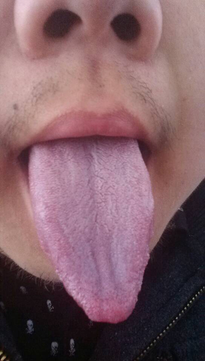 舌苔有裂纹 (23)