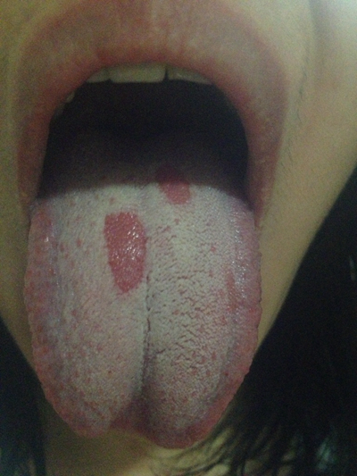 舌苔有裂纹 (26)