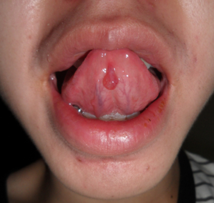 肠癌舌头症状图片图片