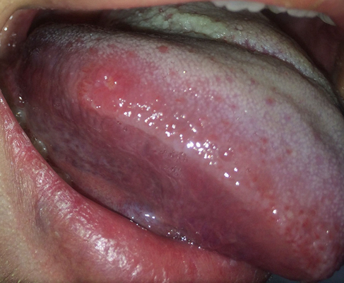 舌癌边缘早期图片图片