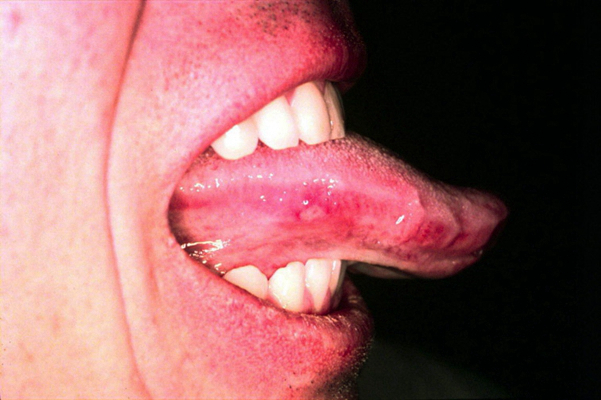 舌癌的初早期症状图片 (34)