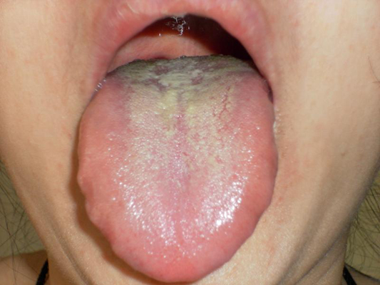 舌癌的初早期症状图片 (12)