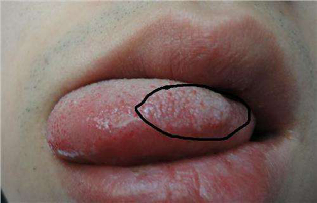 早期结肠癌舌头图片图片