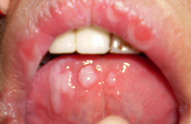 舌癌的初早期症状图片 (15)