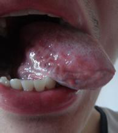 早期结肠癌舌头图片图片